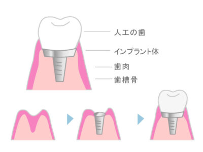 インプラントとは?