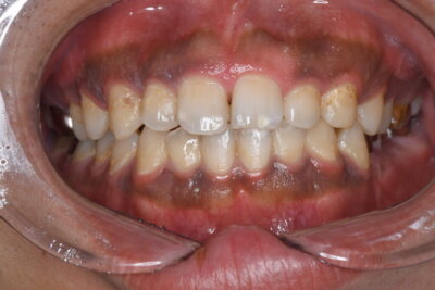 歯茎の黒ずみ除去（術前）