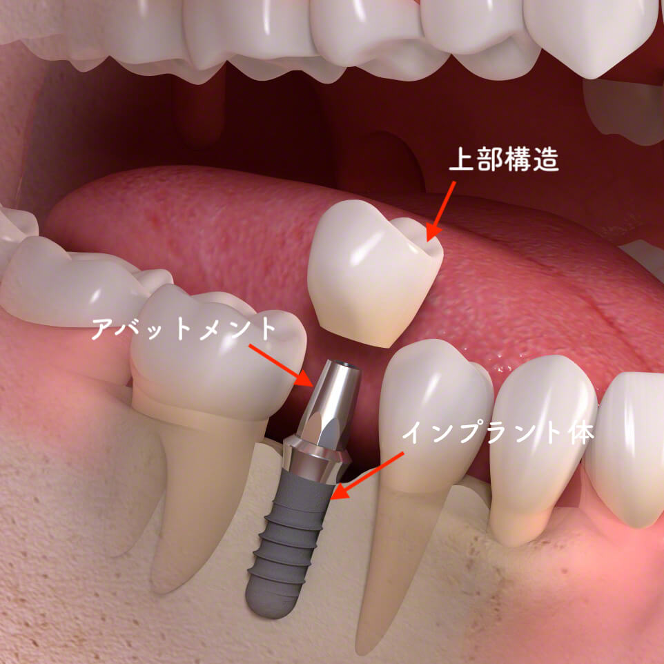 インプラント構造
