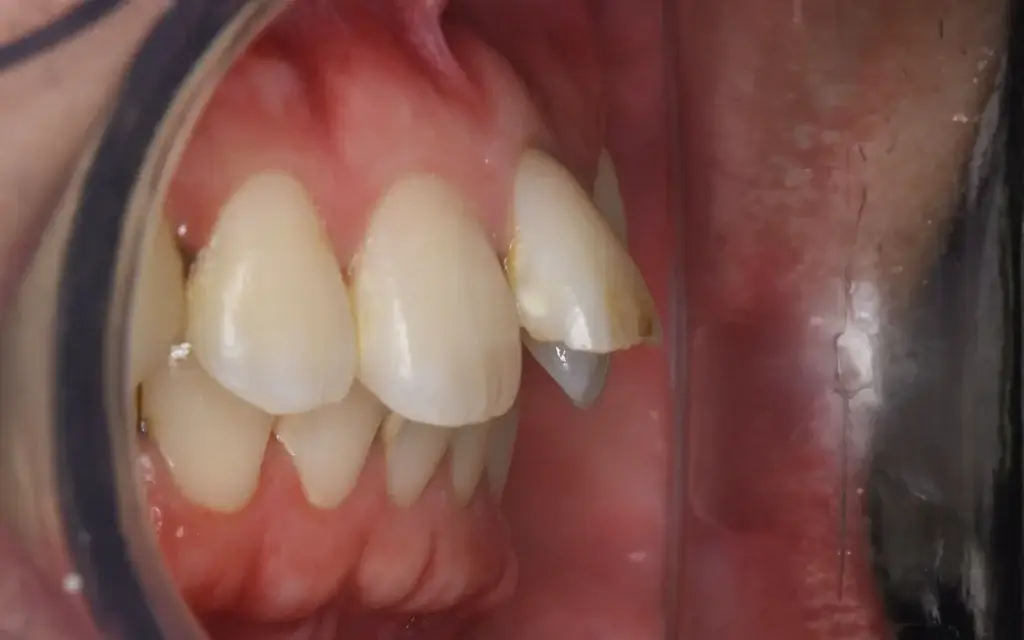 前歯部矯正術前側面
