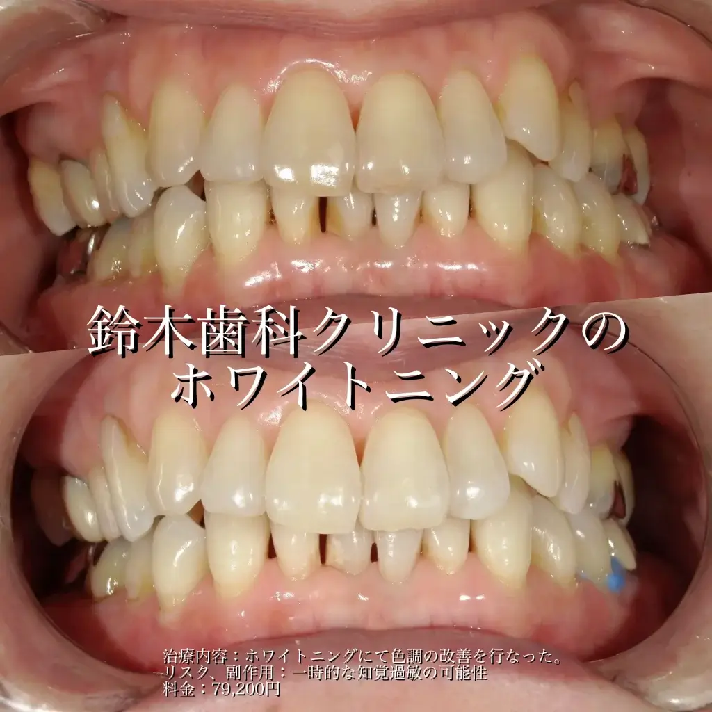 ホワイトニング症例写真2