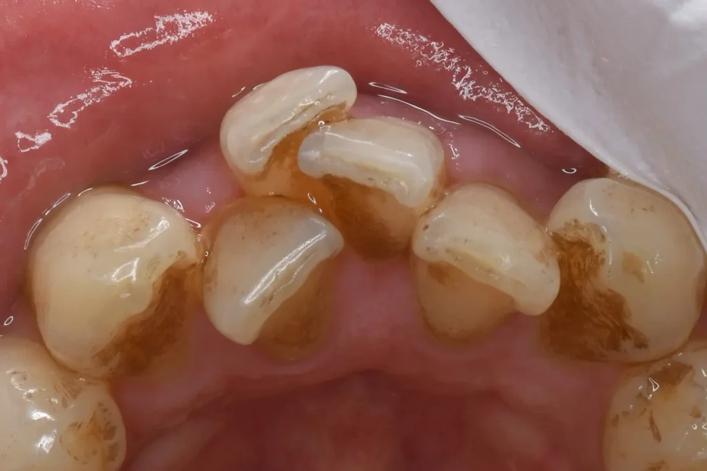 初診時下の歯の前歯