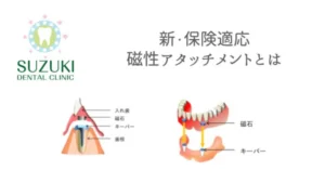 保険適応「義歯の磁性アタッチメント」っていいの？