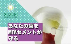 歯を守るMTAセメント治療の本気