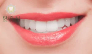 オフィスホワイトニングとホームホワイトニングの効果とリスク。