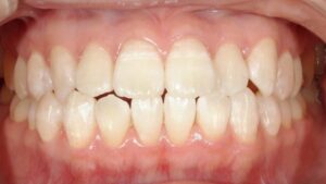 オフィスホワイトニング（20代女性）