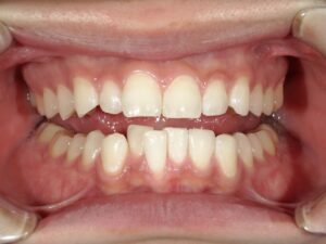 オフィスホワイトニング（30代男性）