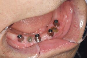 インプラントオーバーデンチャー（70代男性）