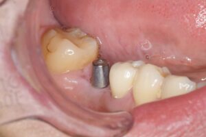 奥歯の1回法インプラント（30代男性）