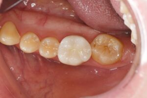 奥歯のセラミック治療（20代男性）