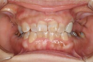 奥歯3本のインプラント（60代女性）