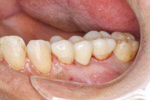 奥歯のセラミックブリッジ治療（50代男性）