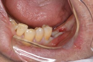 骨造成を伴う奥歯のインプラント2本（70代男性）