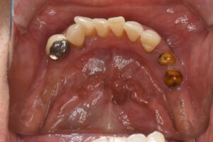 スマートデンチャー（ノンクラスプデンチャー）での入れ歯治療　その2（60代女性）