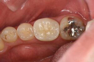 奥歯のセラミック治療（40代男性）