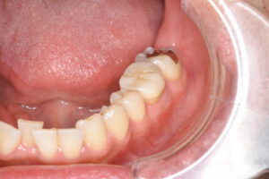 奥歯のセラミック治療（40代男性）