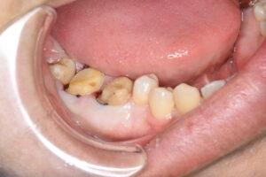 奥歯のセラミック治療（30代男性）