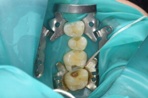 ダイレクトボンディング（30代男性）