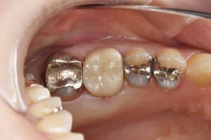 奥歯のセラミック治療（40代女性）