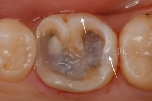 e-maxセラミックアンレーによる虫歯治療（30代女性）