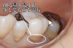 奥歯のセラミック治療（50代女性）