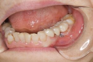 奥歯のセラミックブリッジ（70代女性）その2