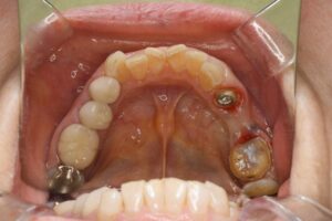 奥歯のセラミックブリッジ（70代女性）その1