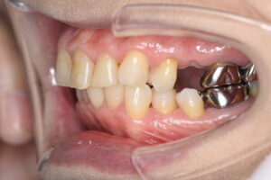 奥歯のストローマンインプラント（60代女性）