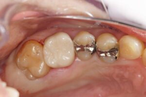 VPT奥歯の歯髄温存療法・セラミック治療（30代男性）