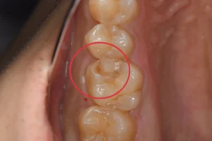 欠けた歯をダイレクトボンディングで治療（30代男性）