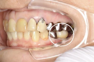 ストローマンインプラント（60代女性）