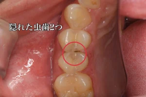 奥歯2本の虫歯をダイレクトボンディングで治療（20代男性）