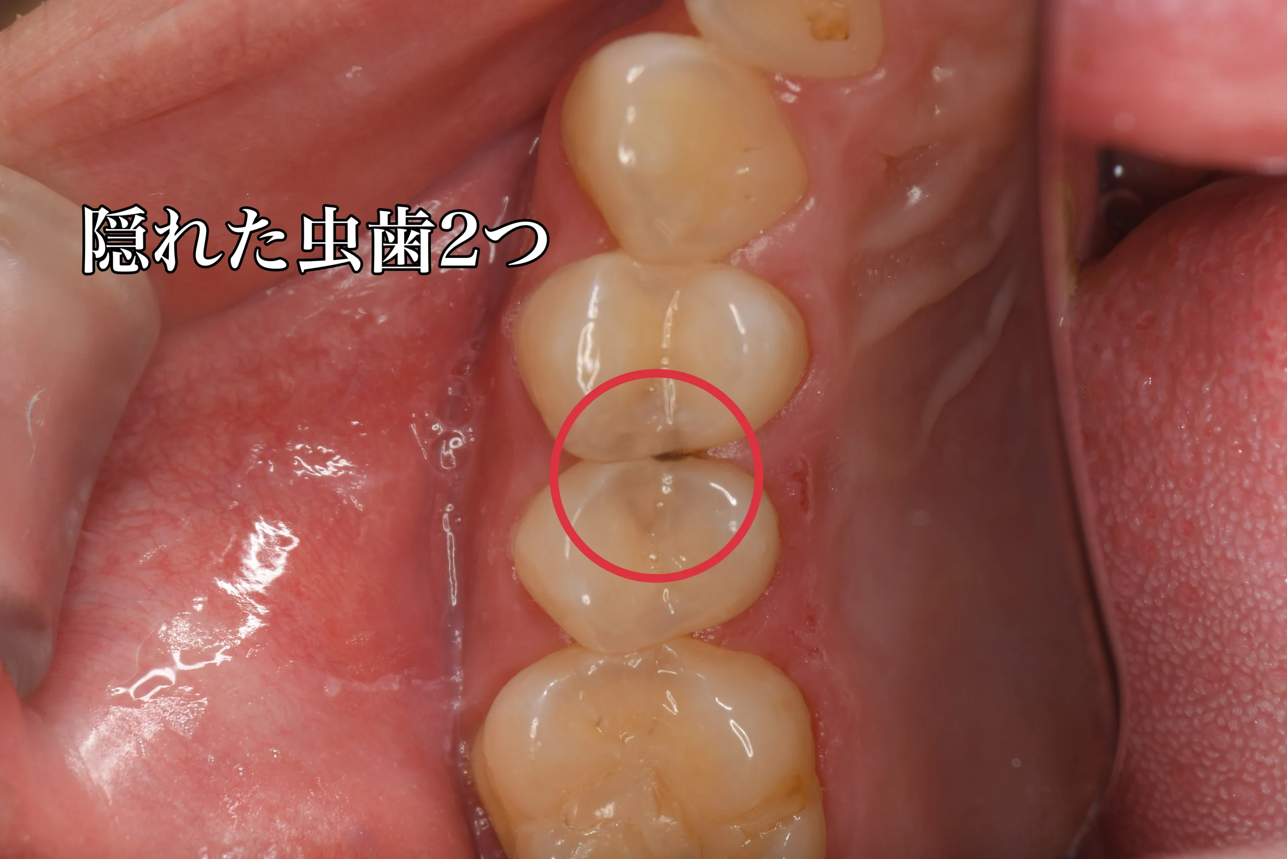 奥歯2本の虫歯をダイレクトボンディングで治療（20代男性） 瑞穂区の