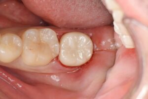 再根管治療後の奥歯のセラミック治療（20代男性）