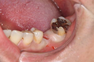 ストローマンインプラント（40代男性）