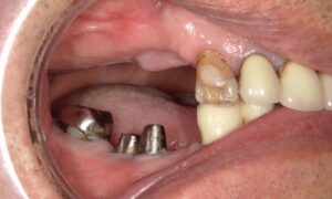 前医の治療の修正と複数本インプラント（70代男性）