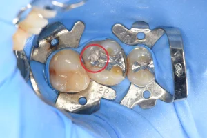 VPT歯髄温存療法後のジルコニア治療（20代男性）