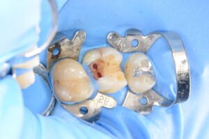 ジルコニア治療前のVPT歯髄温存療法（20代男性）